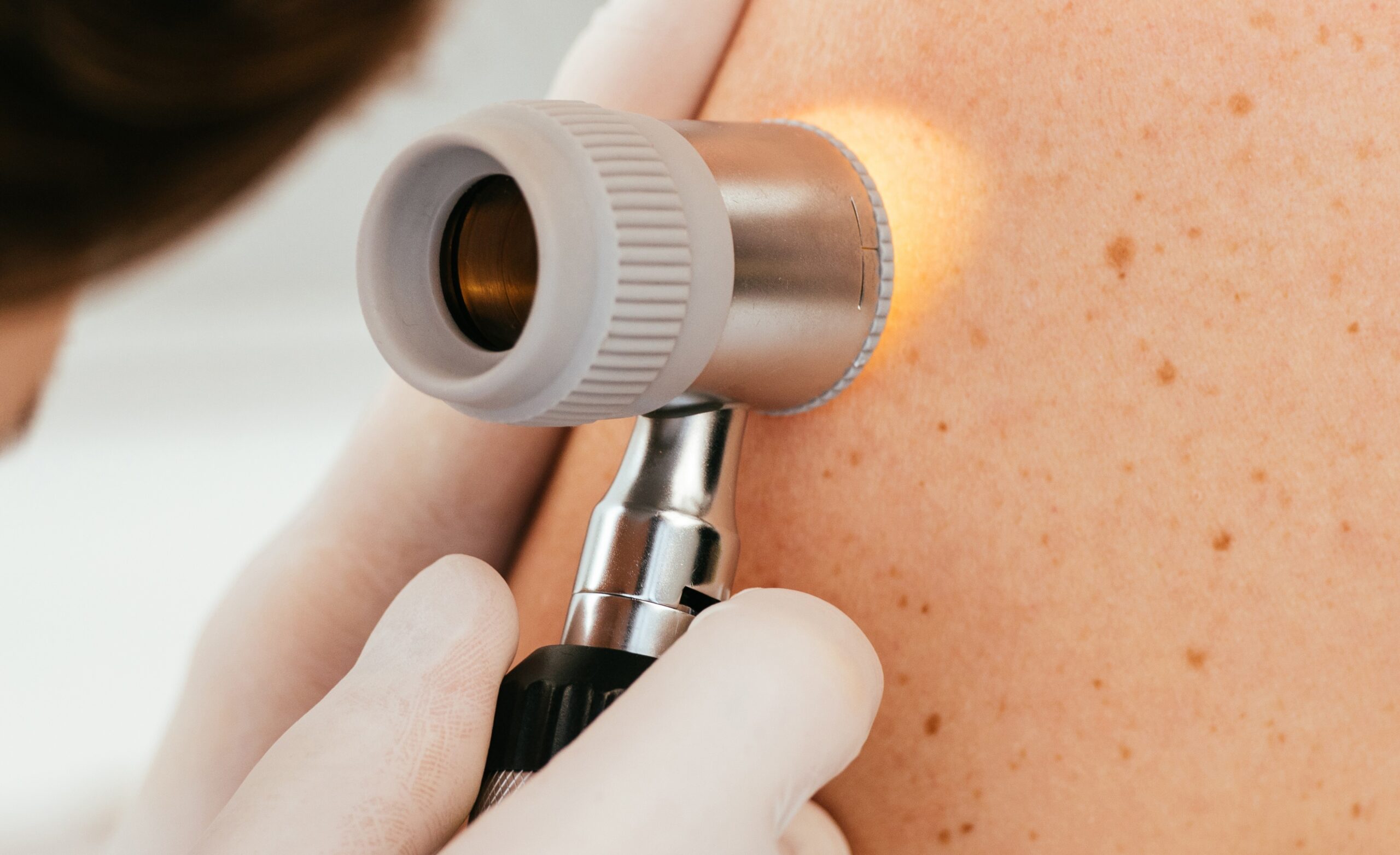 Iznenađujuće otkriće: Najsmrtonosniji oblik raka kože nije melanom ...